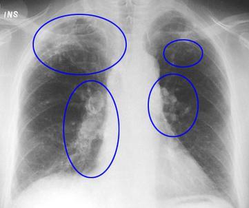 Chest X-ray showing several abnormal areas highlighted with blue circles, indicating possible irregularities or lesions in the lungs and central chest area, as part of a Hostplus member health screening initiative. Chest X-ray showing several abnormal areas highlighted with blue circles, indicating possible irregularities or lesions in the lungs and central chest area, as part of a Hostplus member health screening initiative.