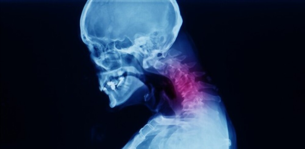 Neck Fusion Explained Neck Fusion Explained